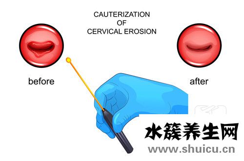 子宮附件囊腫