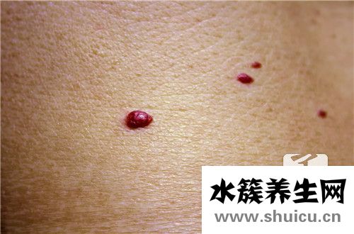 頭上長疙瘩怎么回事