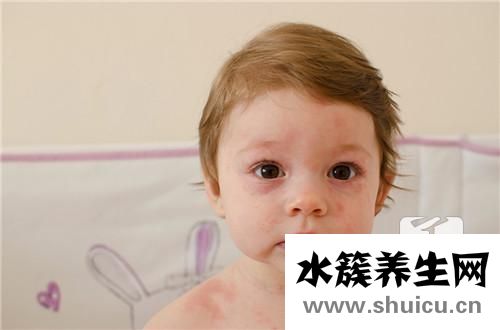 為什么會得蕁麻疹