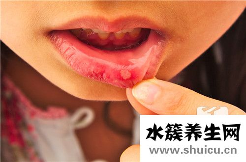 口舌生瘡