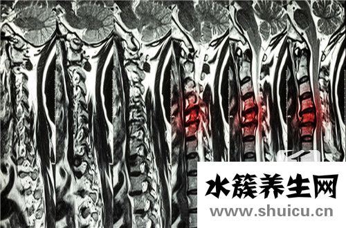 脊髓灰質炎病毒