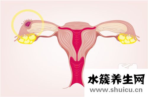 異位妊娠