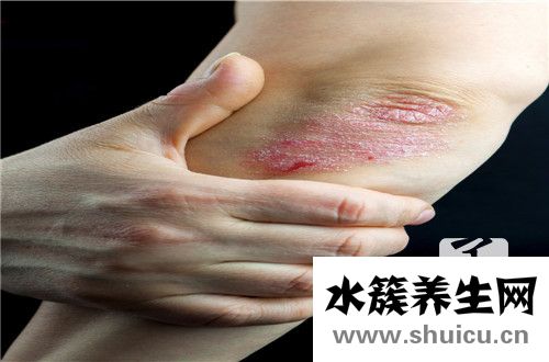 結締組織病