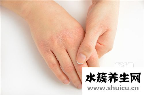 結締組織病