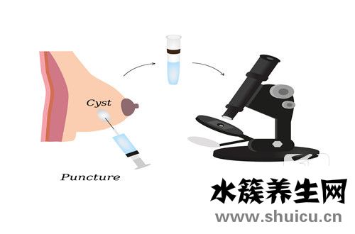 乳腺囊腫