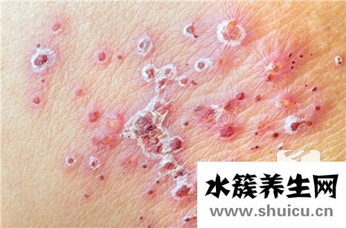 劃痕性蕁麻疹