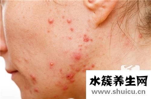 劃痕性蕁麻疹