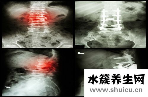 脊柱炎的癥狀
