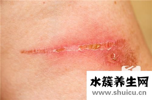 增生性疤痕