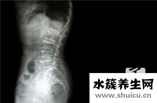 骨刺