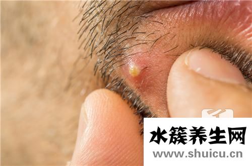 眼角內長了個小白膿點