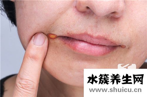 口腔內壁發白