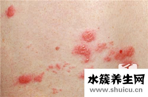 背上長了個硬疙瘩