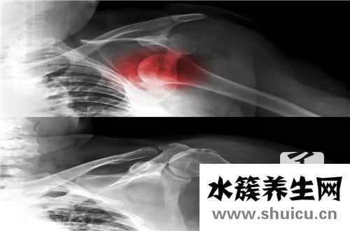 橫突骨折