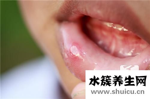 潰瘍吃什么藥