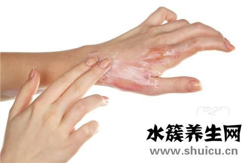 輕度燙傷后怎么處理