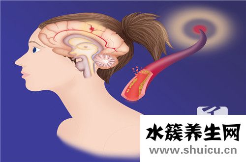 女人腦供血不足癥狀