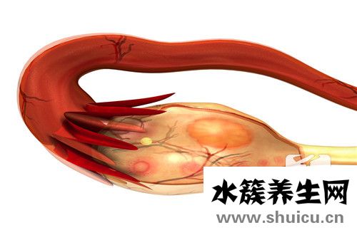 多巢囊腫