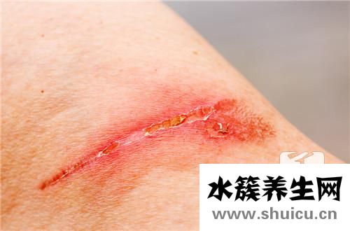 縫針疤痕能去掉嗎