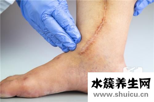 縫針疤痕能去掉嗎