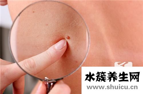 肌纖維瘤
