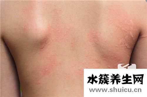 壓力性紫癜