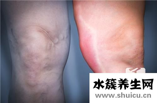 滑膜炎什么癥狀