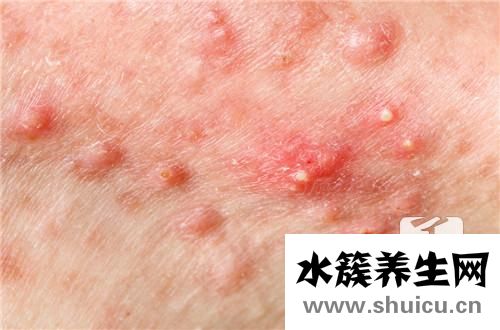 痘痘閉口
