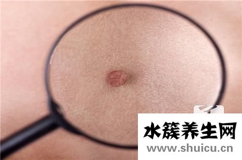 痘痘閉口