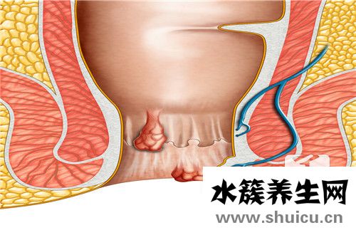 痔瘡復發