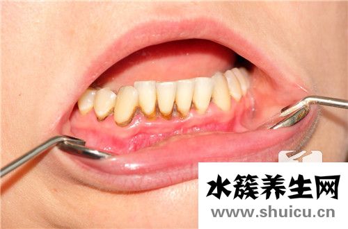 牙齒開裂辦