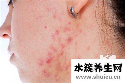 排毒祛痘方法