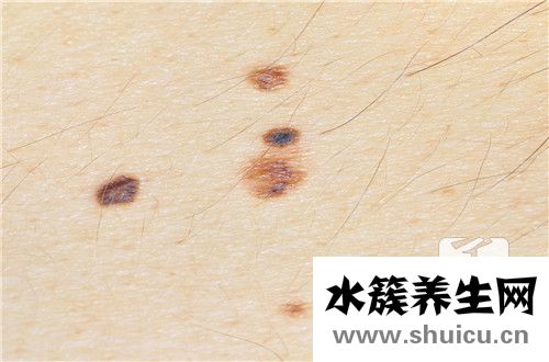 點痣留疤去除