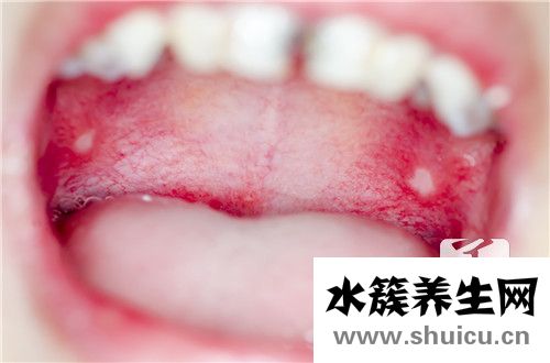 口腔潰爛