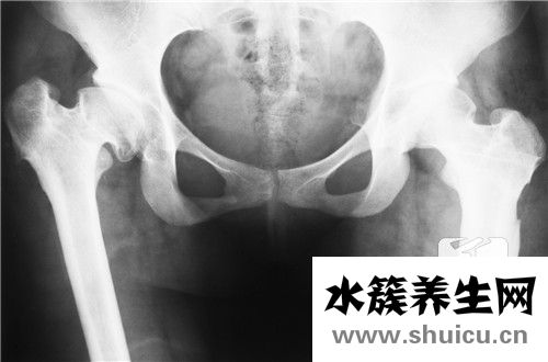 雙側骶髂關節炎