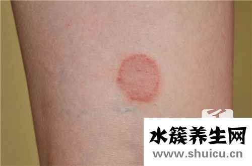 風團治療