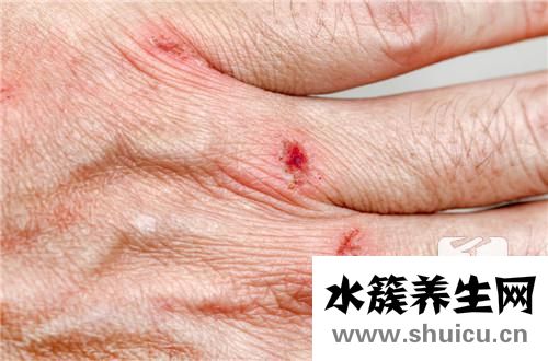 外傷去疤痕