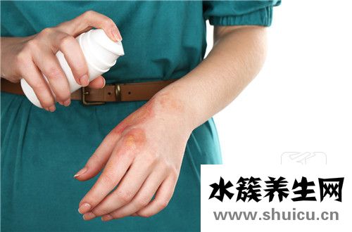 被馬蜂蟄了