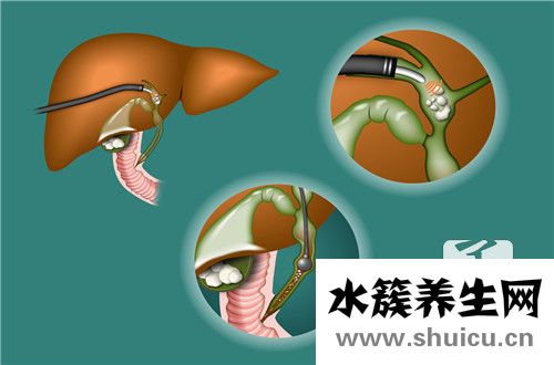 尿管結石