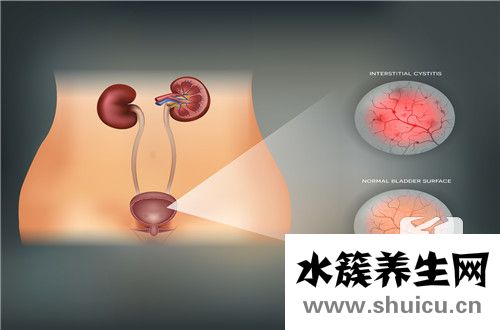 膀胱囊腫