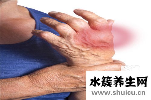 治風濕關節炎最好藥