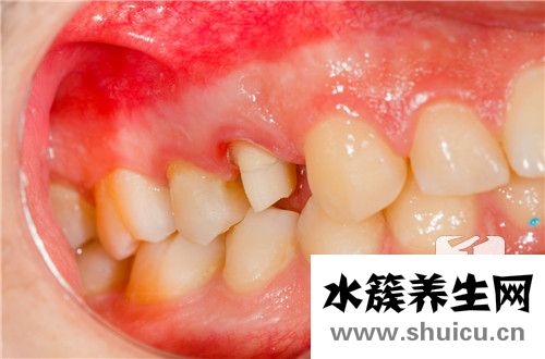 補牙治療