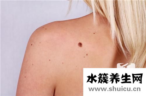 胎記激光治療
