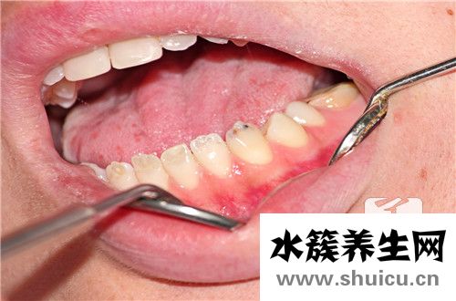 上頜骨囊腫