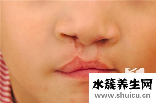 嘴唇裂口