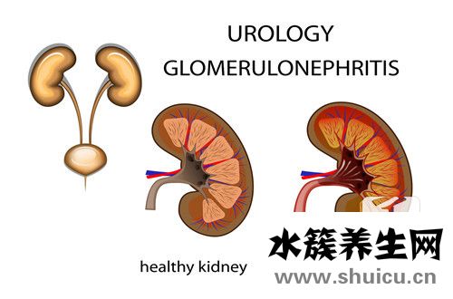 尿常規正常會有腎病嗎
