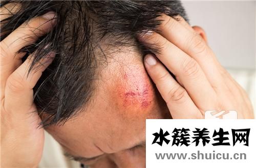 黏液囊腫
