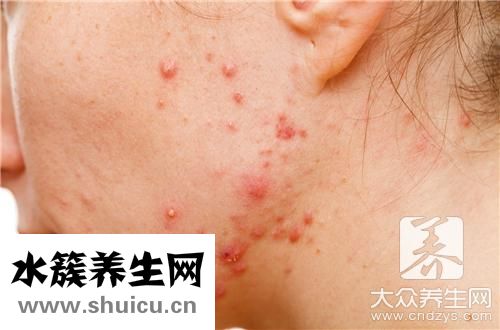 濕疹癢嗎