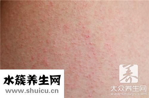 濕疹治療