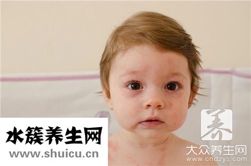 眼瞼神經性皮炎